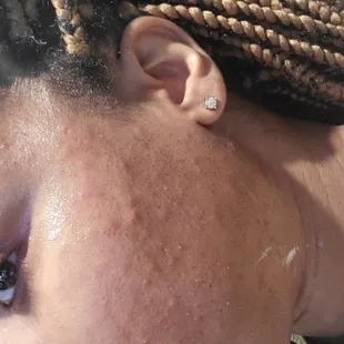 After laser hair removal