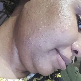 This is after laser hair treatment