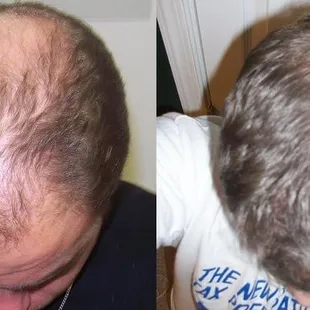 Before and After Laser Hair Therapy