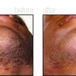 Before and After Folliculitus Barbae  Treatment Hair Removal