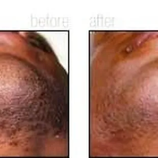 Before and After Folliculitus Barbae  Treatment Hair Removal