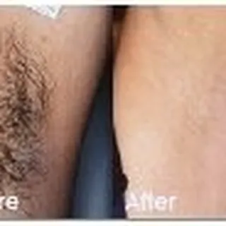 Laser Hair Removal