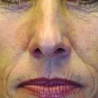 Laser Skin Tightening