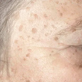 Laser Sun Spot Removal