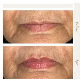 Lip filler, Revance product
