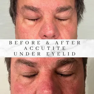 Accutite laser for under the eyes. Decrease the puffiness.