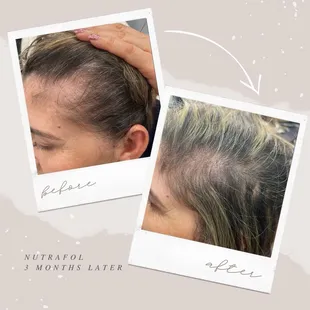 Nutrafol vitamins to help with hair growth