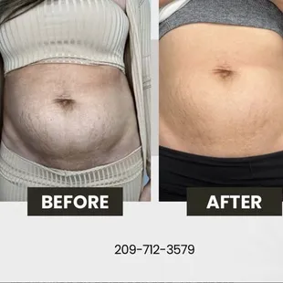 Morpheus 8 microneedling radio frequency