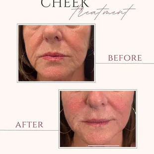 Revance RH cheek filler to improve volume loss