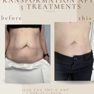 Morpheus 8 body laser treatment. Microneedling radio frequency.