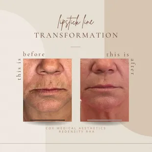 Redensity dermal filler. This filler gives is a natural look while smoothing out the small lines around your lips.