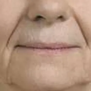 Juvederm, before nasolabial folds and lips