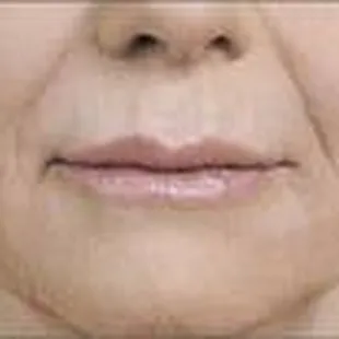 Juvederm, after nasolabial folds and lips