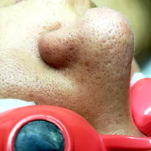 Extractions are an essential part of facials. The worst way to get rid of these minor imperfections is to pick them yourselfs.