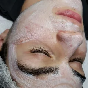 Treating him 1x monthly for the past 3months, skin has really improved. Oily acneic &amp;irritated skin due to over the counter acne products.