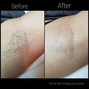Since we started waxing the under arm area her hairs have thinned out nicely, on her 4th waxing session with me. Message me for more info.