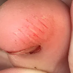 One of the cuts on my granddaughter. Looks like a mans razor.