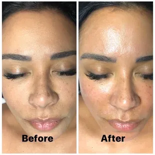Signature facial with microdermabrasion.
