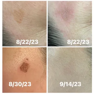 Hyperpigmentation Treatments