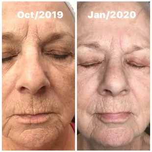 Microneedling can build your collagen and elastin.