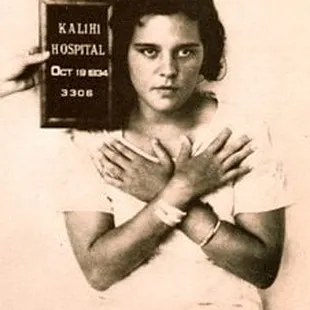 Leprosy patient at Molokai's leper colony.