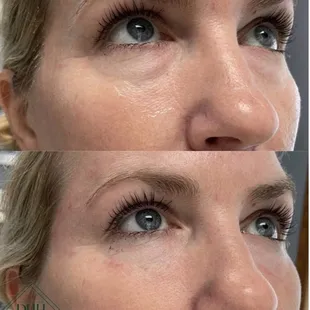 Undereye Filler