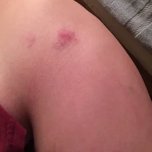 Bruising on my left side from a physical assault endured at the Diamond Ballroom on 1/22/16 around 830pm.