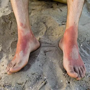 burns on my feet (i was wearing sandles)