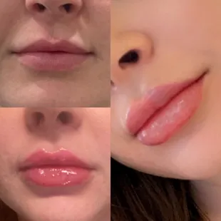Before, 1ml filler, Touched up with another 1ml for two full 2ml and a even more full and beautiful lip!