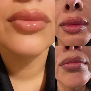 Before , right after and healed 1ml lip filler