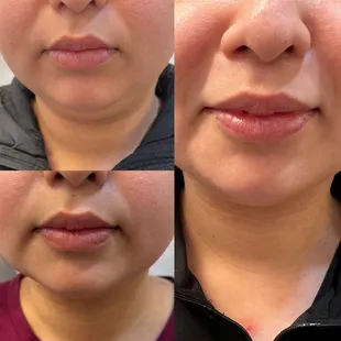 Chin fat dissolver Before , immediately after, and 3 days later.