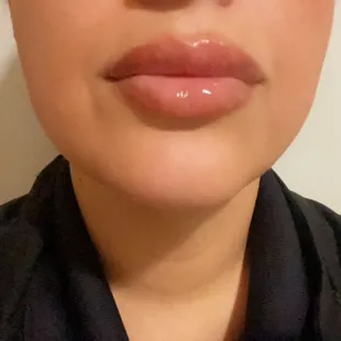 1ml of Restylane kysse