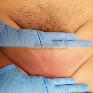 Here we have a before and after of a client who was 4 weeks out.