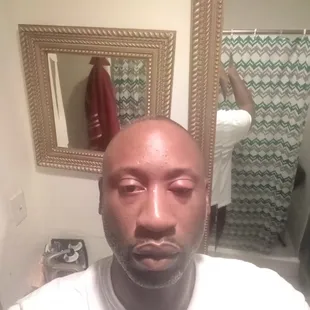 My burger had hair in it, face swell up, I ate half of it. I went backand video footage of staff with no hairnet and no gloves