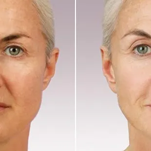 Before and after Juvederm