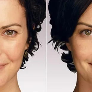 Before and after Juvederm