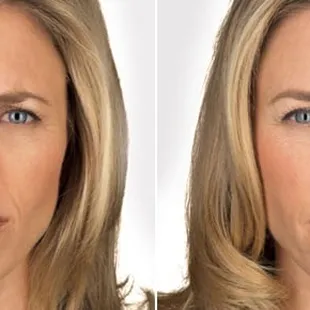 Before and after Botox