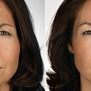 Before and After Botox