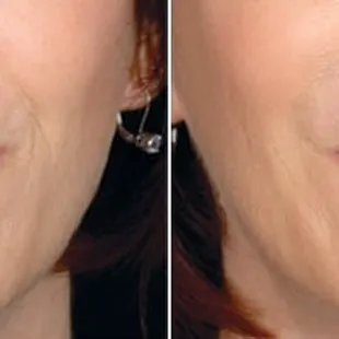Before and after Restylane