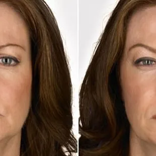 Before and after Botox