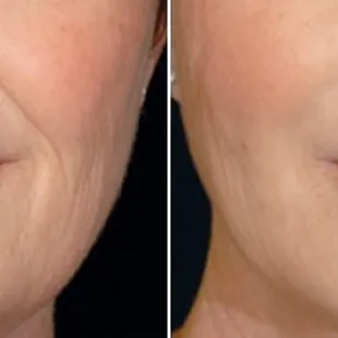 Before and after Restylane