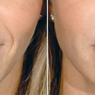 Before and after Restylane