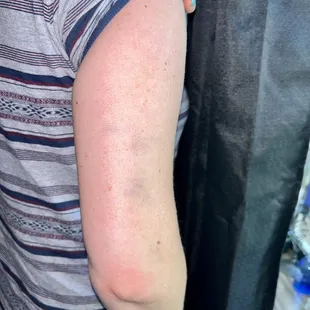 Bruised arm from security