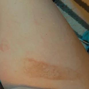 Larger scar from sizzling pan. Hand for reference.