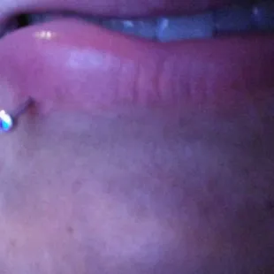 This is a lil after the swelling started to go down and they changed it to a extra long bar this does not show how bad it really was.