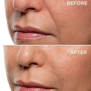 Bellafill (5-10 year filler) builds collagen and increases fullness.