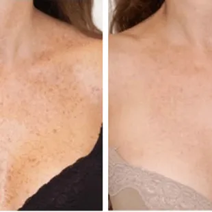 Before and after 1 IPL treatment for skin discoloration.