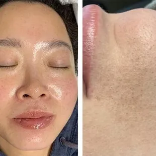 Before/After Hydrafacial-customized for what each patient needs.