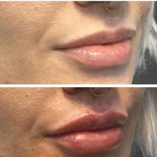 Lip Augmentation-Before/After one syringe