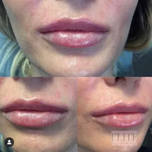 Beautiful after pic of one syringe of lip filler by Cece, Nurse Injector